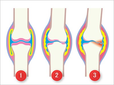 ひざ関節症の進行図